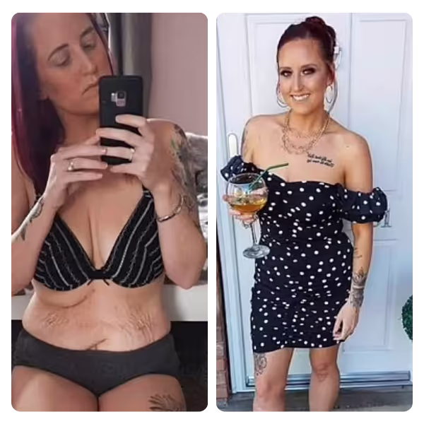 Tummy Tuck in Turkey